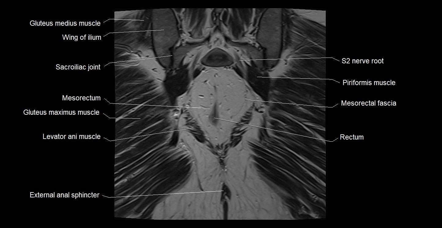 MRI coronal cross sectional anatomy male pelvis image 35.webp